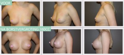 Round breast implants 380cc