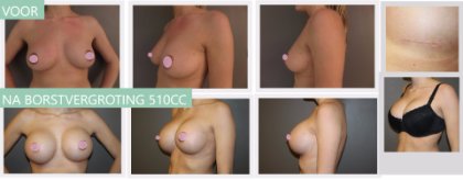Round breast implants 510cc