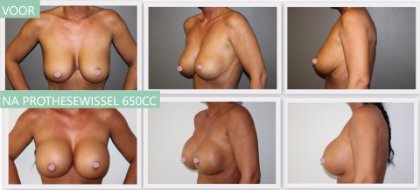 Round breast implants 650cc