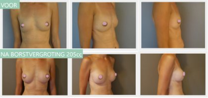 Round breast implants 205cc 