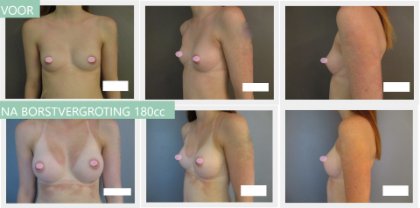 Round breast implants 180cc