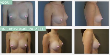Round breast implants 230cc
