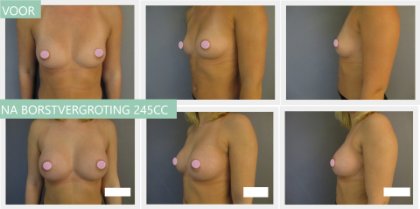 Round breast implants 245cc