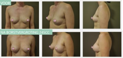 Round breast implants 245cc