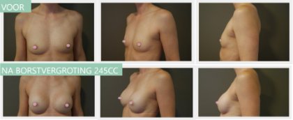 Round breast implants 245cc