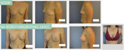 Round breast implants 245cc