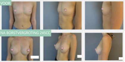 Round breast implants 245cc
