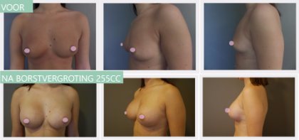 Round breast implants 255cc