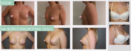Round breast implants 265cc