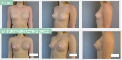 Round breast implants 295cc
