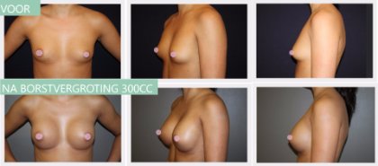 Round breast implants 300cc