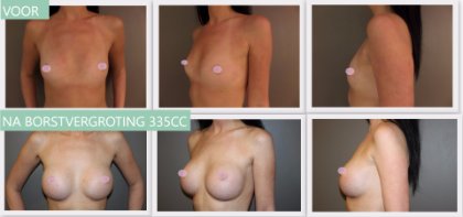 Round breast implants 335cc