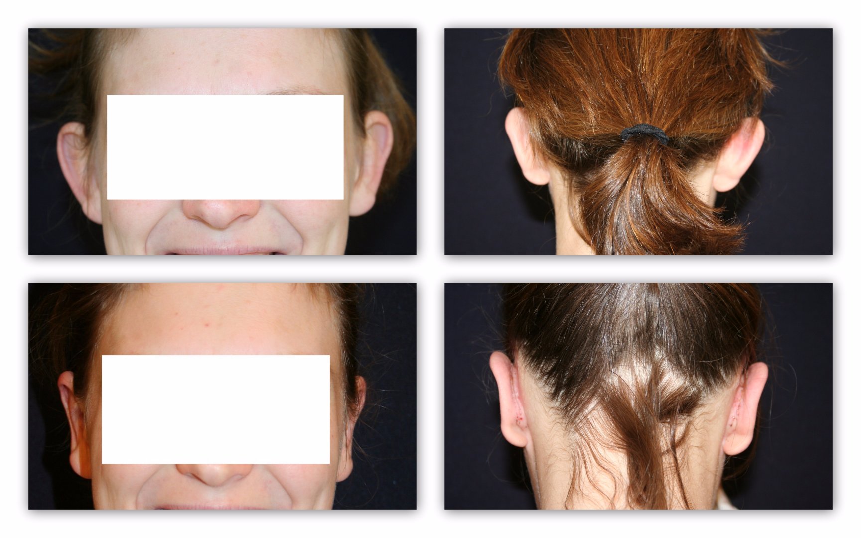 Ear correction before and after photos - Global Care ...