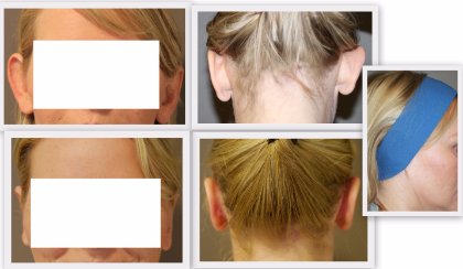 Ear correction Dr. Nelissen - Global Care Clinic