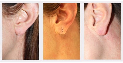 Earlobe correction Dr. Nelissen - Global Care Clinic