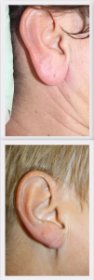 Earlobe reduction Dr. Nelissen - Global Care Clinic