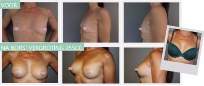 Anatomical breast implants 255cc