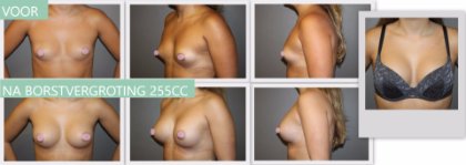 Anatomical breast implants 255cc