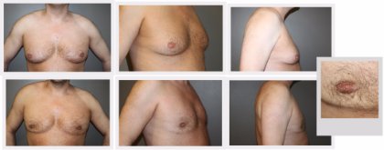 GYNAECOMASTIA (male breast reduction)