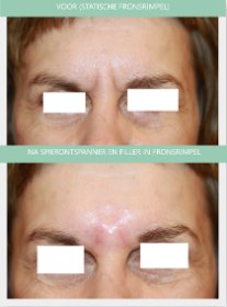 Botox and Radiesse filler in frown wrinkle