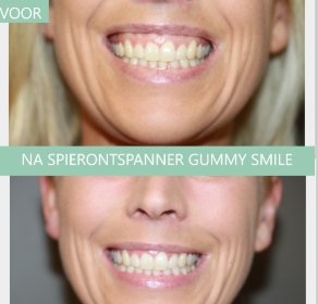 Botox gummy smile voor en na