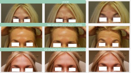 Botox voor en na voorhoofd en frons