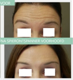 Botox voorhoofdsrimpel