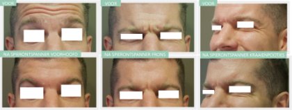 Botox man before and after Dr Nelissen
