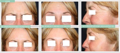 Botox before and after Dr Nelissen