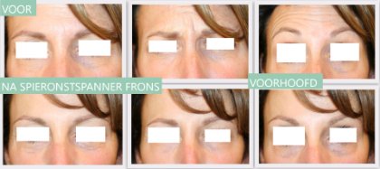 Botox voor en na frons en voorhoofd