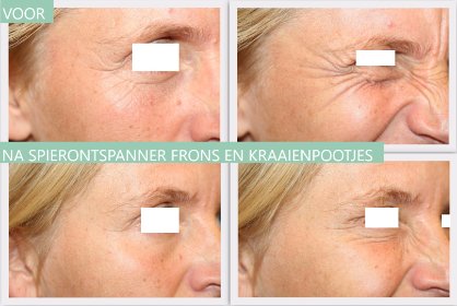 Botox frons en kraaienpootjes