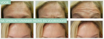 Botox voorhoofd en frons 