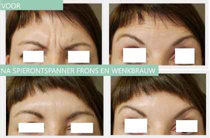 Botox frons en wenkbrauwlift