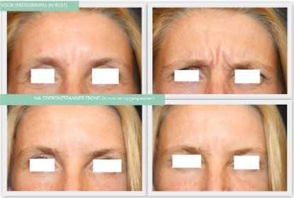 Botox rustrimpel frons