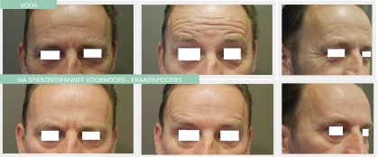 Botox Männer Stirnrunzeln Krähenfüße