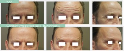 Botox man forehead - crow's feet