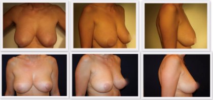 Brustverkleinerung vorher nachher Bilder Plastischer Chirurg Dr Nelissen #globalcareclinic