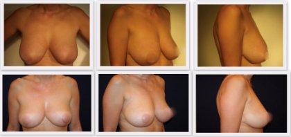 Breast reduction before and after photos Plastic Surgeon Dr Nelissen #globalcareclinic