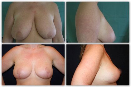 Breast reduction before and after photos Plastic Surgeon Dr Nelissen #globalcareclinic