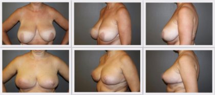 Breast reduction before and after photos Plastic Surgeon Dr Nelissen #globalcareclinic