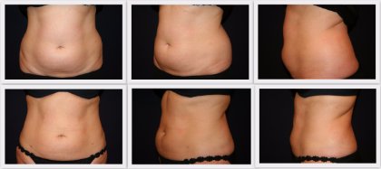 Liposuction tummy Dr. Nelissen - Global Care Clinic