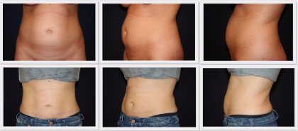 Liposuction tummy Dr. Nelissen - Global Care Clinic