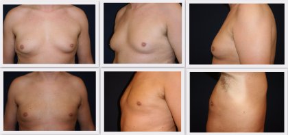 Liposuction breast area man Dr. Nelissen - Global Care Clinic