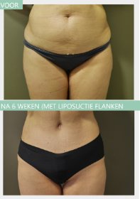 Buikwandcorrectie + liposuctie 6 weken