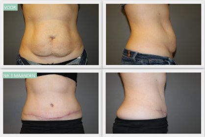 Tummy Tuck Before and After 3 Months