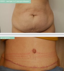 Tummy Tuck before and after 4 weeks 