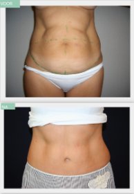 Tummy Tuck Before and After