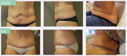 Tummy tuck before and after