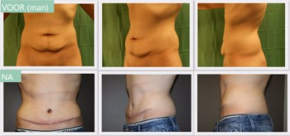 Tummy tuck man