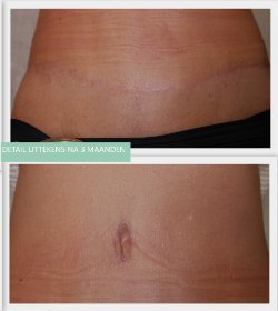Tummy Tuck scars after 3 months
